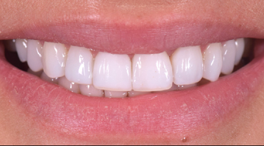 After - Advanced Dentistry Dental Advanced Dentistry - After