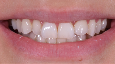 Before - Advanced Dentistry Dental Advanced Dentistry - Before
