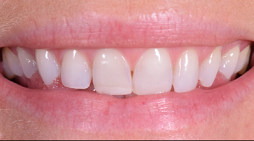 Before - Advanced Dentistry Dental Advanced Dentistry - Before