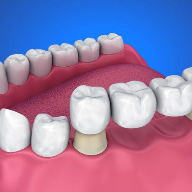 Dental Bridges