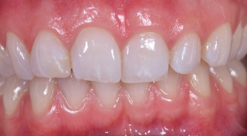 Before - Advanced Dentistry Dental Advanced Dentistry - Before