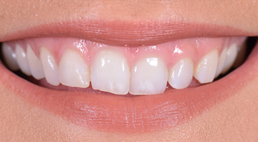 Before - Advanced Dentistry Dental Advanced Dentistry - Before