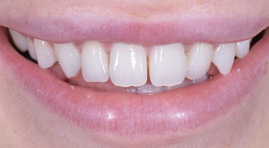 Before - Advanced Dentistry Dental Advanced Dentistry - Before
