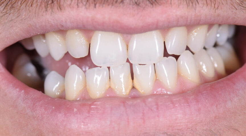 Before - Advanced Dentistry Dental Advanced Dentistry - Before