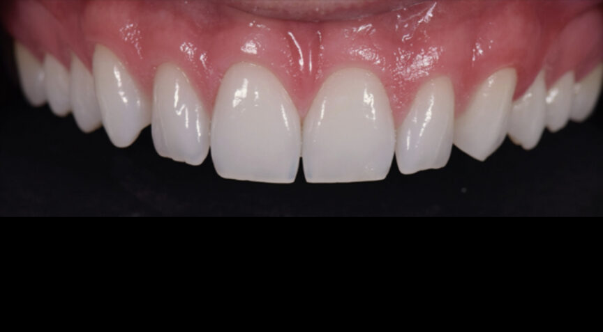 Before - Advanced Dentistry Dental Advanced Dentistry - Before