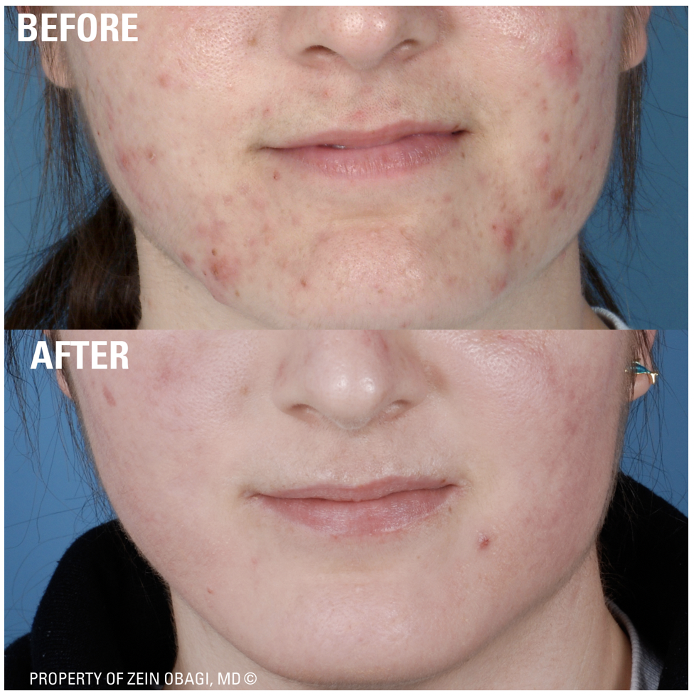 ZO Skincare - Before and After