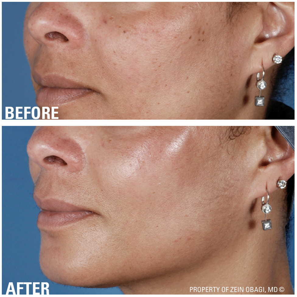 ZO Skincare - Before and After