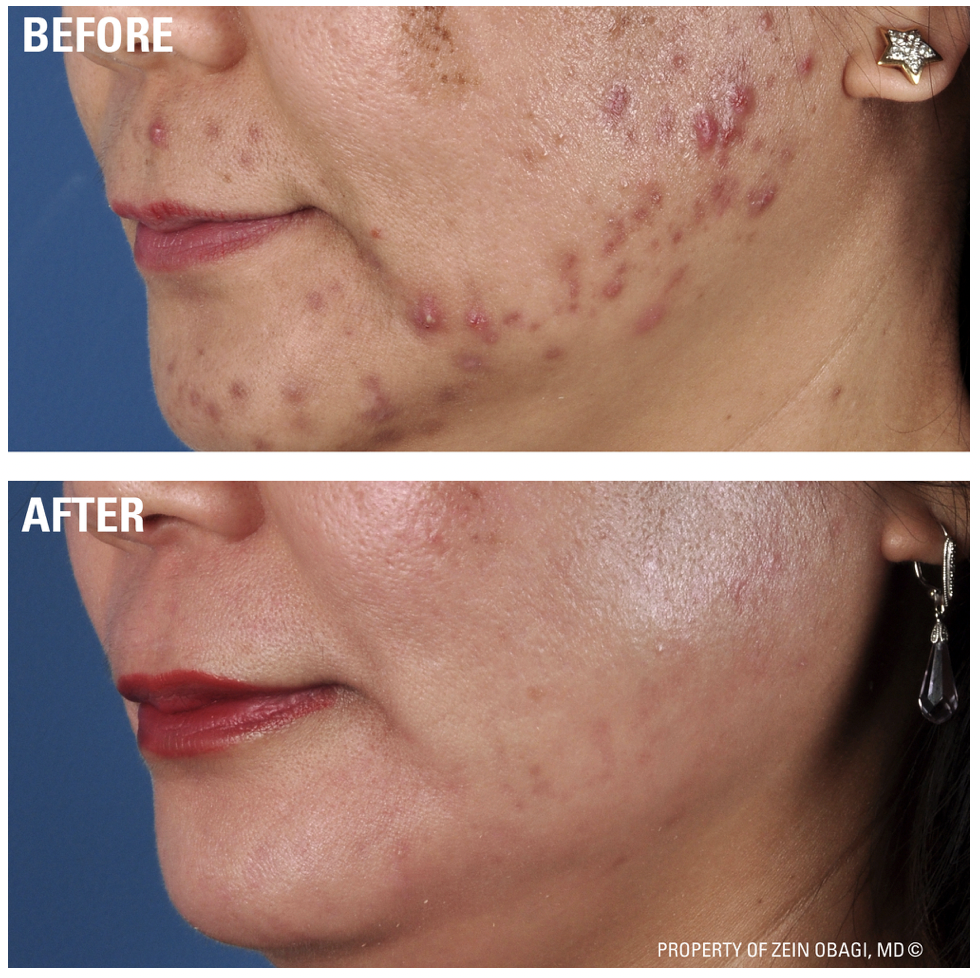 ZO Skincare - Before and After