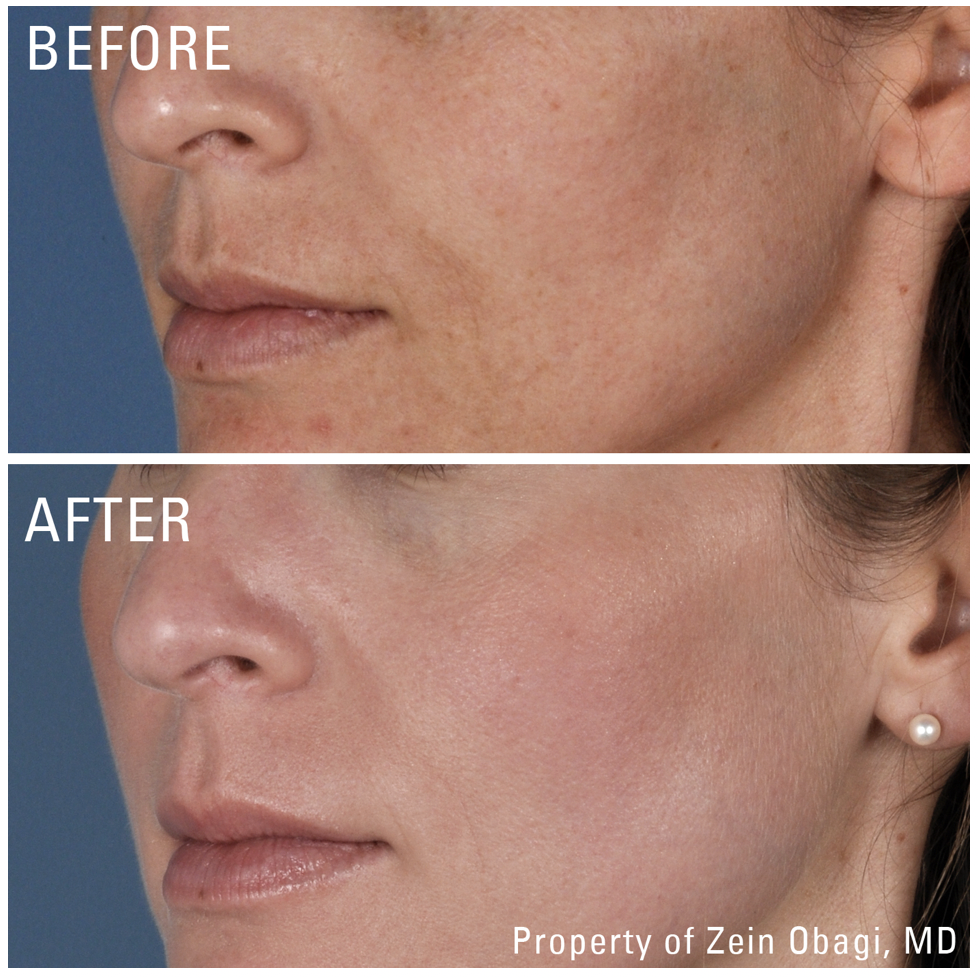 ZO Skincare - Before and After